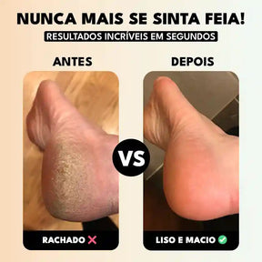 Lixa Elétrica Portátil CallusCare: Pés Macios, Remove Calos e Rachaduras Facilmente